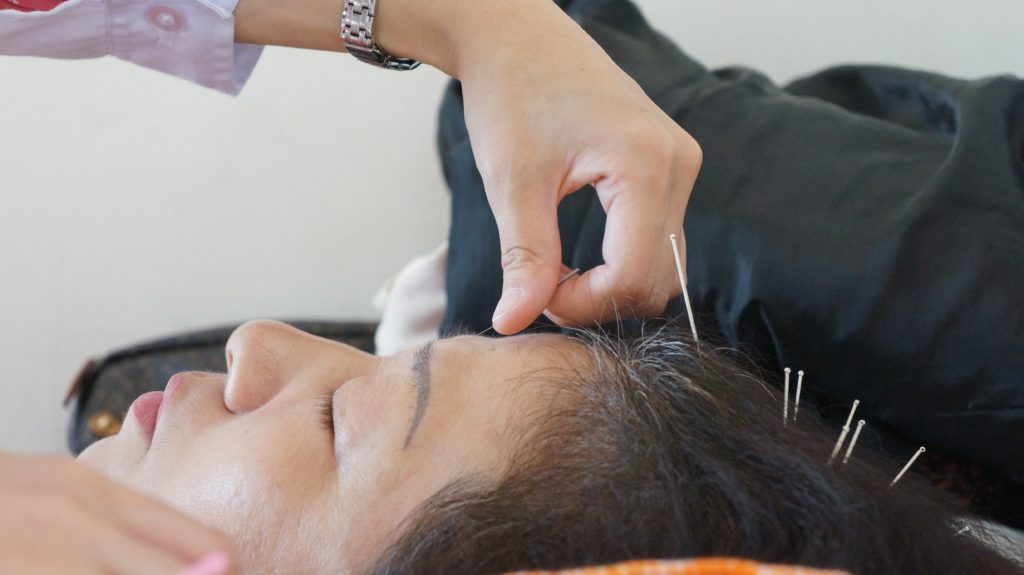 The calming effect of acupuncture